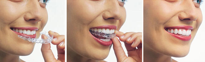 Clear Aligners